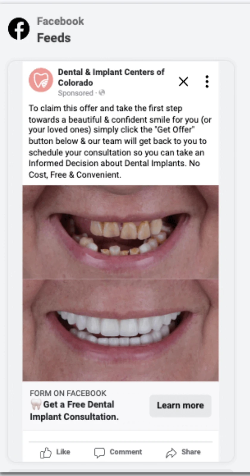 Facebook ad: free dental implant consultation, with a lead form on Facebook.